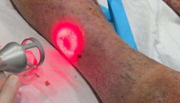 Chronic wounds ulcer K-Laser Photobiomodulation