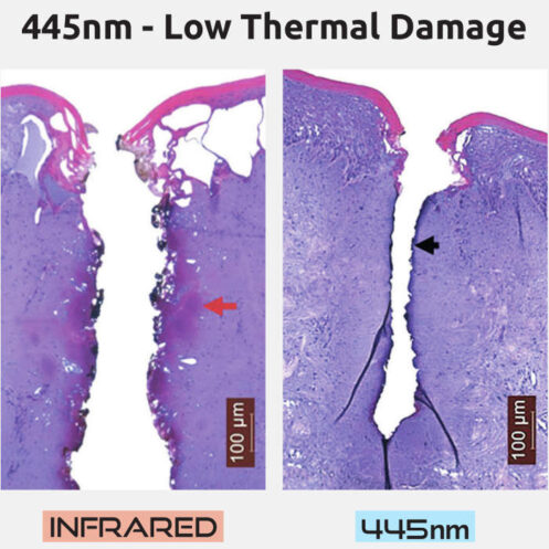 IR-Laser-Thermal-Damages